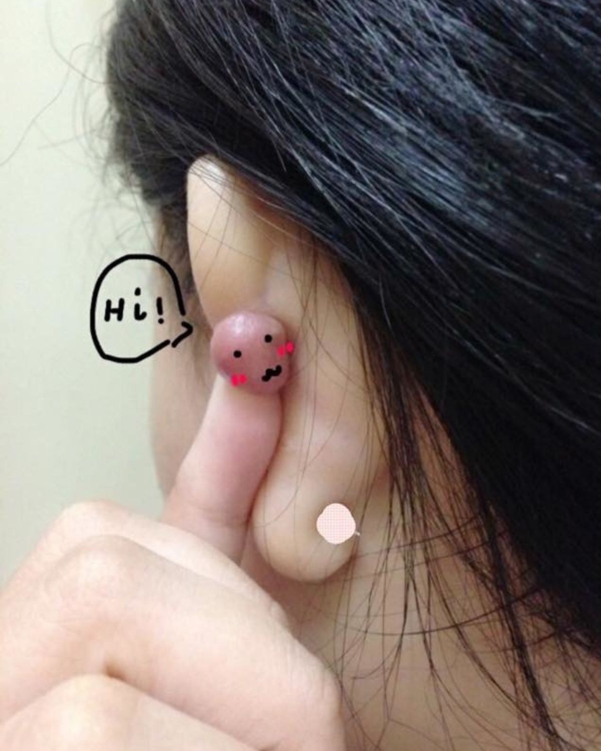 xỏ khuyên tai bị lồi thịt